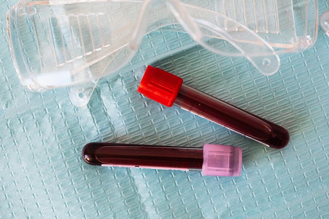 Blood sample for thyroid function testing